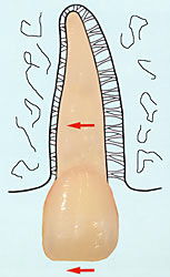 Skizze: Zahnbewegung durch Druck