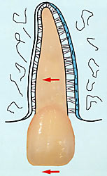 Skizze: Knochenanbau auf der Zugseite