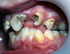 Hässlich zahnspange Gerade Zähne